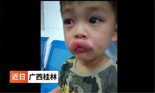 吃小瓜嘴肿,揭秘夏日美食背后的健康隐患